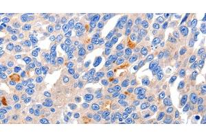 Immunohistochemistry of paraffin-embedded Human liver cancer tissue using KCNH8 Polyclonal Antibody at dilution 1:50 (KCNH8 抗体)