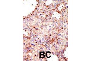 Formalin-fixed and paraffin-embedded human cancer tissue reacted with ARFGAP1 polyclonal antibody  , which was peroxidase-conjugated to the secondary antibody, followed by AEC staining . (ARFGAP1 抗体  (C-Term))