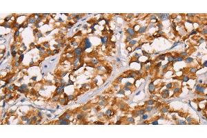 Immunohistochemistry of paraffin-embedded Human thyroid cancer using SPR Polyclonal Antibody at dilution of 1:40 (SPR 抗体)