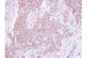 IHC-P Image Immunohistochemical analysis of paraffin-embedded human lung Papillary adenocarcinoma, using CD81, antibody at 1:250 dilution. (CD81 抗体)