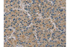The image on the left is immunohistochemistry of paraffin-embedded Human liver cancer tissue using ABIN7130528(PAGE2 Antibody) at dilution 1/20, on the right is treated with fusion protein. (PAGE2 抗体)