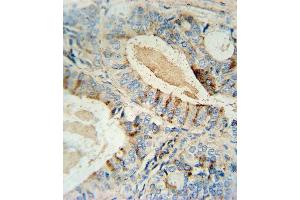 GCNT2 antibody (C-term) (ABIN654173 and ABIN2850475) immunohistochemistry analysis in formalin fixed and paraffin embedded human prostate carcinoma followed by peroxidase conjugation of the secondary antibody and DAB staining.