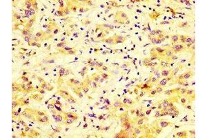 IHC image of ABIN7150786 diluted at 1:600 and staining in paraffin-embedded human liver cancer performed on a Leica BondTM system. (DUSP9 抗体  (AA 142-263))