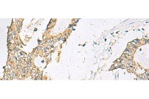 Immunohistochemistry of paraffin-embedded Human colorectal cancer tissue using SPACA1 Polyclonal Antibody at dilution of 1:50(x200) (SPACA1 抗体)