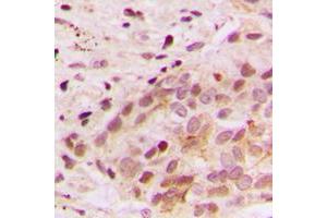 Immunohistochemical analysis of ERK3 staining in human breast cancer formalin fixed paraffin embedded tissue section. (MAPK6 抗体  (Center))
