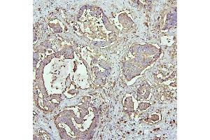 IHC analysis of CEACAM5 using anti-CEACAM5 antibody (ABIN7601435).