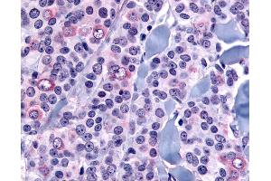 Anti-NANP antibody IHC of human Breast, Carcinoma. (NANP 抗体  (Internal Region))