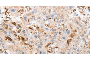 Immunohistochemistry of paraffin-embedded Human lung cancer tissue using SLC15A2 Polyclonal Antibody at dilution 1:60 (SLC15A2 抗体)