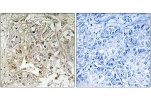 Immunohistochemistry analysis of paraffin-embedded human liver carcinoma tissue, using p38 MAPK (Ab-179/181) Antibody. (MAPK14 抗体  (AA 151-200))