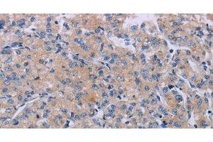 Immunohistochemistry of paraffin-embedded Human prostate cancer using P2RX3 Polyclonal Antibody at dilution of 1:50 (P2RX3 抗体)