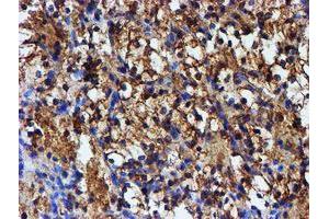 Immunohistochemical staining of paraffin-embedded Carcinoma of Human kidney tissue using anti-IDS mouse monoclonal antibody. (IDS 抗体)