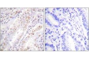 Immunohistochemistry analysis of paraffin-embedded human lung carcinoma, using XRCC2 Antibody. (RCC2 抗体  (AA 211-260))