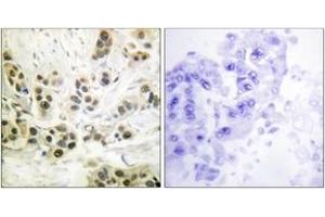 Immunohistochemistry analysis of paraffin-embedded human breast carcinoma, using Lamin A/C (Phospho-Ser392) Antibody. (Lamin A/C 抗体  (pSer392))