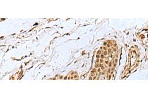 Immunohistochemistry of paraffin-embedded Human esophagus cancer tissue using WRNIP1 Polyclonal Antibody at dilution of 1:35(x200) (WRNIP1 抗体)