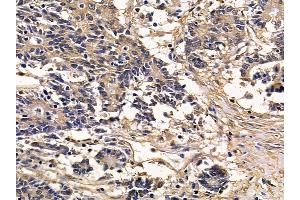 TGM2 Mouse Monoclonal Antibody at 1/100 staining human colorectal cancer by IHC-P.