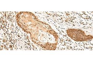 Immunohistochemistry of paraffin-embedded Human esophagus cancer tissue using MKX Polyclonal Antibody at dilution of 1:60(x200) (MKX 抗体)