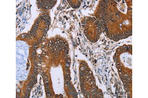 Immunohistochemistry of Human lung cancer using IHH Polyclonal Antibody at dilution of 1:30 (Indian Hedgehog 抗体)