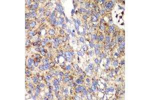 Immunohistochemistry of paraffin-embedded human lung cancer using SPARC antibody (ABIN5970787) at dilution of 1/100 (40x lens). (SPARC 抗体)