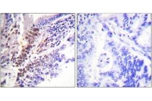 Immunohistochemistry analysis of paraffin-embedded human lung carcinoma, using GR (Phospho-Ser226) Antibody. (GR (AA 201-250), (pSer226) 抗体)