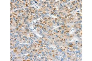Immunohistochemical analysis of paraffin-embedded Human liver cancer tissue using at dilution 1/30. (Superoxide dismutase copper chaperone 抗体  (C-Term))