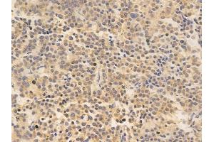 ABIN6265841 and ABIN6266669 at 1/100 staining human pituitary adenoma by IHC-P. (UBA7 抗体  (C-Term))