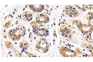 Detection of NFkB in Human Breast cancer Tissue using Polyclonal Antibody to Nuclear Factor Kappa B (NFkB) (NFkB 抗体  (AA 42-367))