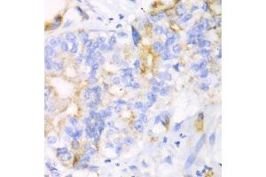 Immunohistochemistry of paraffin-embedded human liver cancer using CHIA antibody. (CHIA 抗体  (AA 1-368))