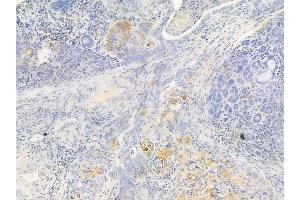 ABIN6262772 and ABIN6267008 at 1/100 staining human esophageal carcinoma by IHC-P. (KRT15 抗体)