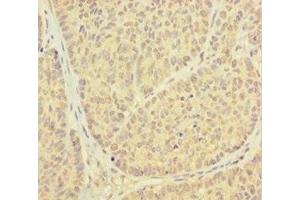 Immunohistochemistry of paraffin-embedded human ovarian cancer using ABIN7164935 at dilution of 1:100 (PSMF1 抗体  (AA 1-271))