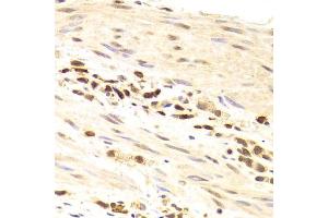 Immunohistochemistry of paraffin-embedded human gastric cancer using PRPF3 Antibody (ABIN5973192) at dilution of 1/100 (40x lens). (PRPF3 抗体)