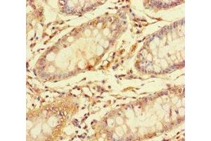 Immunohistochemistry of paraffin-embedded human colon cancer using ABIN7146751 at dilution of 1:100 (CES3 抗体  (AA 65-233))
