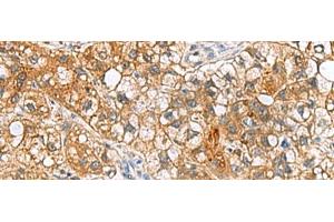 Immunohistochemistry of paraffin-embedded Human liver cancer tissue using TTR Polyclonal Antibody at dilution of 1:50(x200) (TTR 抗体)