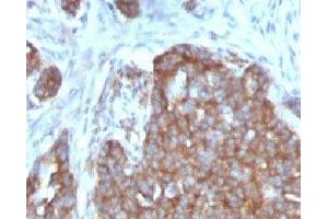 Formalin-fixed, paraffin-embedded human ovarian carcinoma stained with TFF1 antibody. (TFF1 抗体  (C-Term))