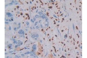 Detection of MASP1 in Human Bile duct cancer Tissue using Polyclonal Antibody to Mannose Associated Serine Protease 1 (MASP1) (MASP1 抗体  (AA 20-447))