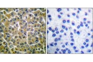Immunohistochemistry analysis of paraffin-embedded human breast carcinoma, using PLCG2 (Phospho-Tyr753) Antibody. (Phospholipase C gamma 2 抗体  (pTyr753))