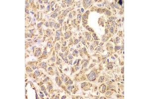 Immunohistochemistry of paraffin-embedded human esophageal cancer using HSPA9 antibody at dilution of 1:200 (400x lens). (HSPA9 抗体)