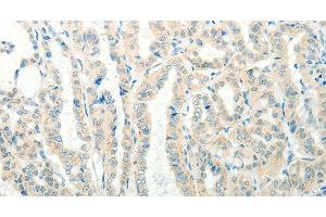 Immunohistochemistry of paraffin-embedded Human thyroid cancer tissue using RAB25 Polyclonal Antibody at dilution 1:50 (RAB25 抗体)