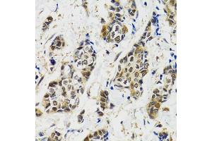 Immunohistochemistry of paraffin-embedded human breast cancer using MAPK9 antibody (ABIN5970592) at dilution of 1/100 (40x lens). (JNK2 抗体)