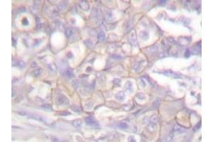 Immunohistochemistry analyzes of Csk antibody in paraffin-embedded human breast carcinoma tissue. (CSK 抗体)