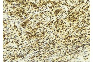 ABIN6277947 at 1/100 staining Human breast cancer tissue by IHC-P. (SIAH2 抗体  (C-Term))