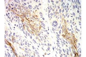 Immunohistochemical analysis of paraffin-embedded esophageal cancer tissues using KRT10 mouse mAb with DAB staining. (Keratin 10 抗体  (AA 345-454))