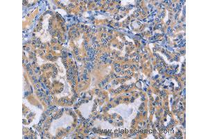 Immunohistochemistry of Human cervical cancer using DOK4 Polyclonal Antibody at dilution of 1:50 (DOK4 抗体)