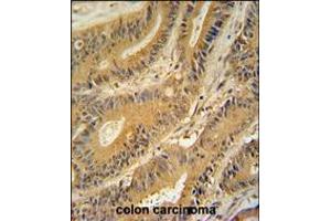 GNAT3 antibody immunohistochemistry analysis in formalin fixed and paraffin embedded human colon carcinoma followed by peroxidase conjugation of the secondary antibody and DAB staining. (GNAT3 抗体  (AA 78-105))