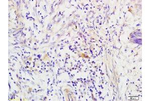 Formalin-fixed and paraffin embedded human colon carcinoma tissue labeled with Anti-RRM1 Polyclonal Antibody, Unconjugated  at 1:200 followed by conjugation to the secondary antibody, (SP-0023), and DAB staining (RRM1 抗体  (AA 733-778))