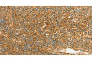 Immunohistochemistry of paraffin-embedded Human liver cancer using APOL2 Polyclonal Antibody at dilution of 1:80 (Apolipoprotein L 2 抗体)