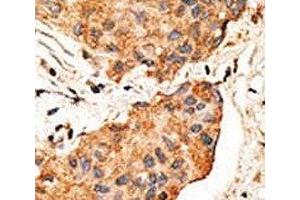 IHC analysis of FFPE human breast carcinoma tissue stained with the NRG1 antibody (Neuregulin 1 抗体  (AA 198-229))