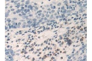 Detection of TNFa in Human Skin cancer Tissue using Polyclonal Antibody to Tumor Necrosis Factor Alpha (TNFa) (TNF alpha 抗体  (AA 77-233))