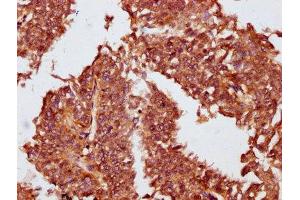 IHC image of ABIN7162115 diluted at 1:100 and staining in paraffin-embedded human cervical cancer performed on a Leica BondTM system. (Obscurin 抗体  (AA 1621-1712))