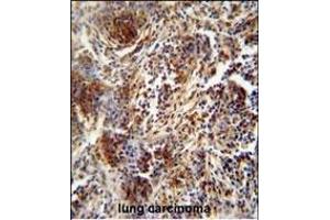 ZNF30 antibody (N-term) (ABIN654563 and ABIN2844269) immunohistochemistry analysis in formalin fixed and paraffin embedded human lung carcinoma followed by peroxidase conjugation of the secondary antibody and DAB staining. (ZFP30 抗体  (N-Term))