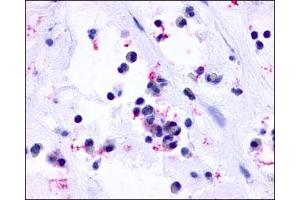 IHC staining of Nasal Mucosa (Allergic Rhinitis Eosinophils) using CysLT1 antibody ABIN122043. (CysLTR1 抗体  (3rd Extracellular Domain))